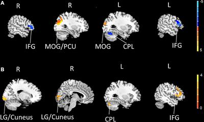 Moxibustion for primary dysmenorrhea: A resting-state functional magnetic resonance imaging study exploring the alteration of functional connectivity strength and functional connectivity